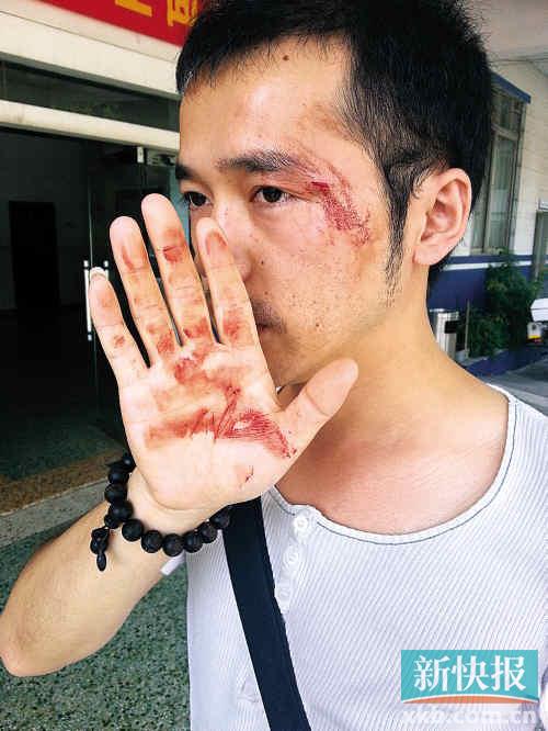 本報(bào)一記者眼角被打傷,流血不止。